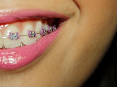 Hello Kitty pink braces
