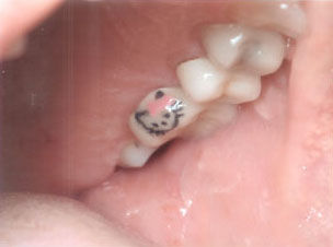 Hello Kitty crown tooth